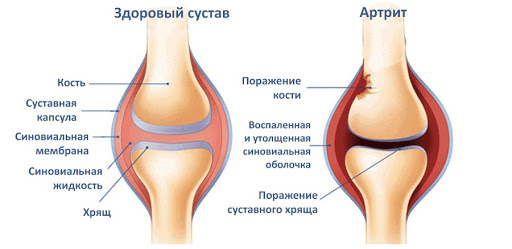 Clinica de artrită de artrită)